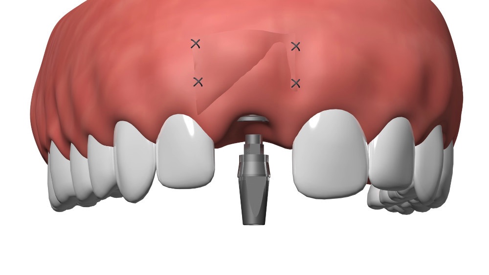 Implant dentaire Nimes